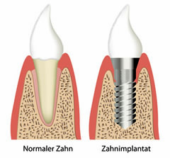 Vergleich Gesunder Zahn - Implantat